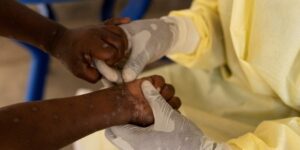 Crise Du Mpox : Les États-Unis Font Don De 10 000 Doses De Vaccin Au Nigéria